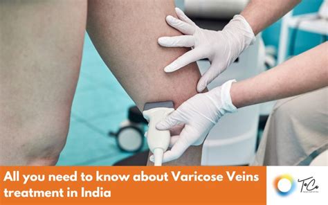 All you need to know about Varicose Veins treatment in India - TaCa ...