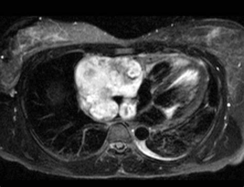 Mr Imaging Of Cardiac Tumors Radiographics