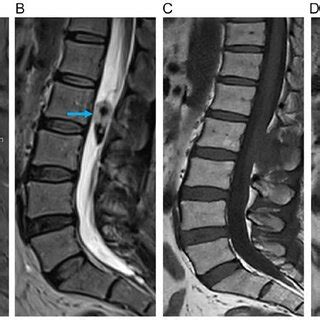 Preoperative And Postoperative Sagittal Mri For Case A