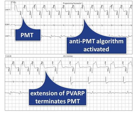 Pacemaker Mediated Tachycardia Microport Academy