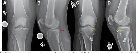 Figure 1 From An Arthroscopic Procedure For Restoration Of