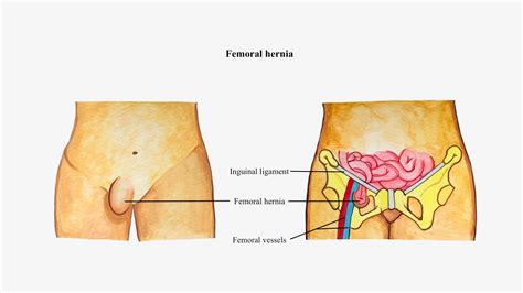 Femoral Hernia Chennaihernia