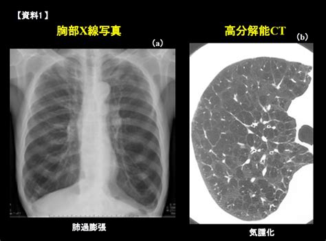 Copdの胸部x線（左・・上下に長く伸びている肺