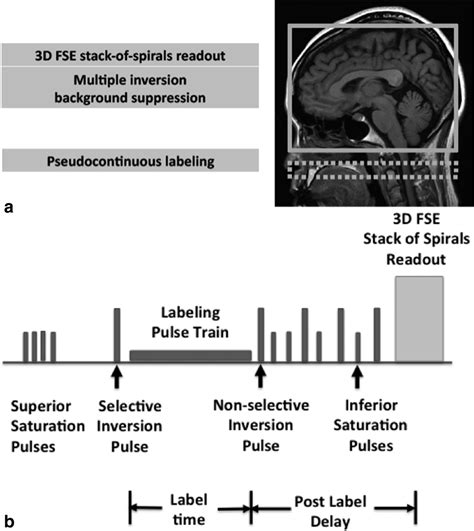 3d Pseudocontinuous Arterial Spin Labeling In Routine Clinical Practice