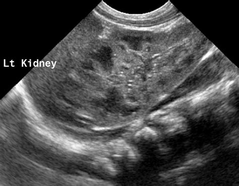 Unilateral Renal Agenesis Image