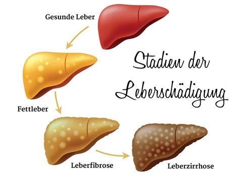 Leberfibrose Med Kom