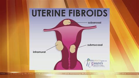 Uterine Fibroids And The Options Available 5 24 16 Youtube