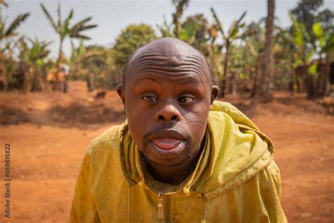 Portrait Of An Adult Bald African Man With Down Syndrome On A Forest