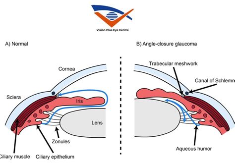 Types of Glaucoma: Open-Angle vs. Angle-Closure