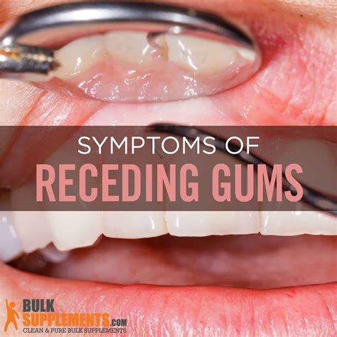 Receding Gums: Symptoms, Causes & Treatment