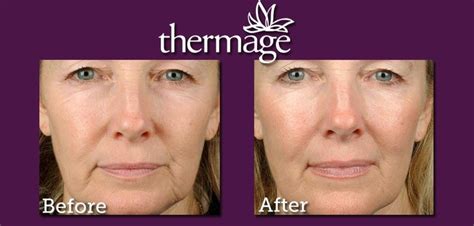 Thermage | Thermage, Skin tightening, Skin