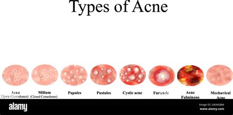 Types of Acne Skin inflammation. Pimples, boils, whitehead, closed comedones, papules, pustules ...