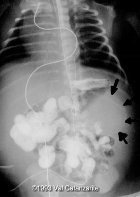 📃 Meconium Peritonitis