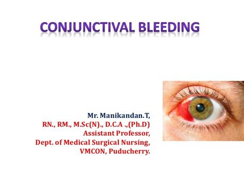 Conjunctival bleeding