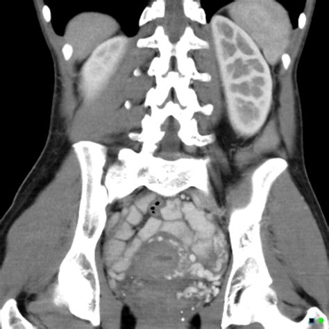 Pelvic Congestion Syndrome Image Radiopaedia Org