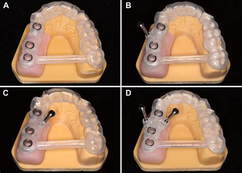 Fixation Pins Increase The Accuracy Of Implant Surgery In Free End