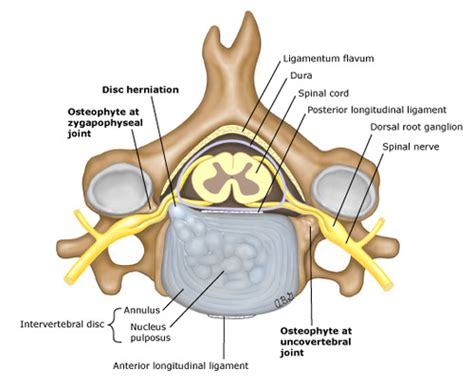 MSD II PT977 Cervical Mobility Deficits Radiculopathy Flashcards