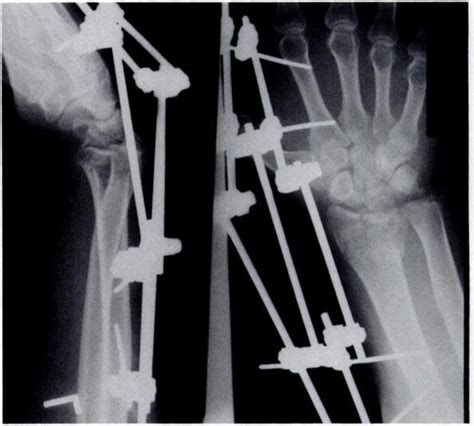 Properly Applied External Wrist Fixation This Fixator Was Applied