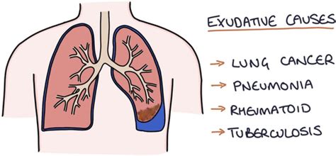 Pleural Effusion Flashcards Quizlet