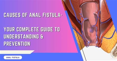 Understanding Anal Fistula A Complete Guide For Healing