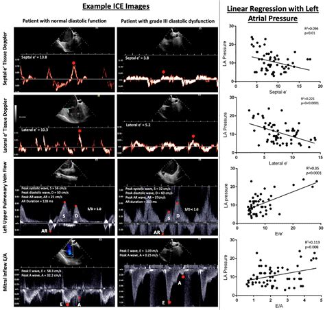 PO 03 065 ASSESSMENT OF LEFT VENTRICULAR DIASTOLIC FUNCTION USING