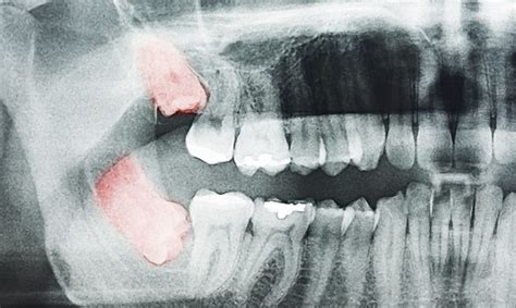 Operación Muelas del Juicio Clínica Dental en Valencia IDIM