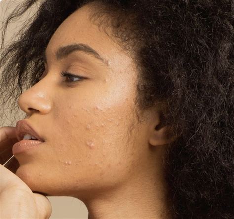 How Should I Care For My Acne Prone Skin — Glow By Nina