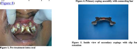 Figure From Prosthodontic Restoration Of A Congenital Premaxillary