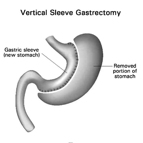 Vertical Sleeve Gastrectomy Download Scientific Diagram