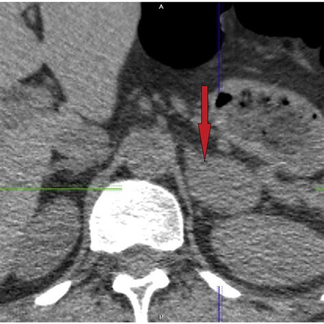 CT-imaging of unidentified mass. | Download Scientific Diagram