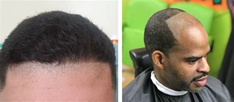 How To Fix A Messed Up Hairline - Wimpole Clinic