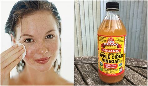 Health Remedies 5 Ways Apple Cider Vinegar Can Improve Your Skin