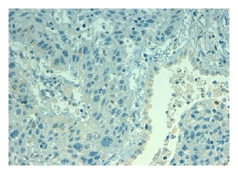 Representative Results Of Ihc Staining Of Nsclc Tumour Specimens For