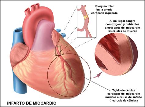 Shock Cardiogenico On Emaze