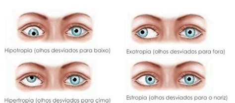 Oftalmologia Rio Cirurgia De Estrabismo