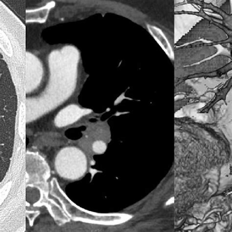 Preoperative Chest Computed Tomography Scan Shows A 3 1 Cm Squamous