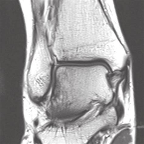 MRI of lateral aspect of the ankle, showing a tear of the CFL ...