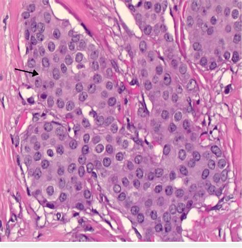 Moderately Differentiated Invasive Ductal Carcinoma Shown By Black Download Scientific Diagram