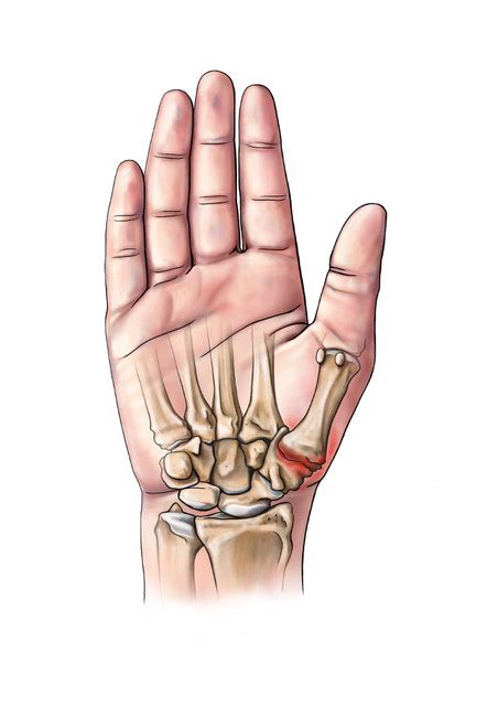 Thumb Basal Joint Arthritis Dr Sonja Cerovac