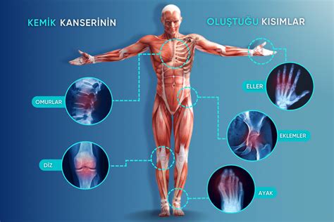 Kemik T M Rleri Belirtileri Ve Tedavi Se Enekleri Nelerdir Turan Turan