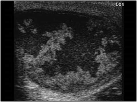 Urinary Tract and male reproductive system | 2.3 Scrotum : Case 2.3.6 ...