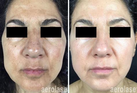 The Future Of Melasma Treatment • Aerolase