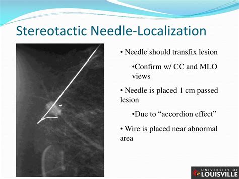 Ppt In Situ Carcinoma Of The Breast Powerpoint Presentation Free