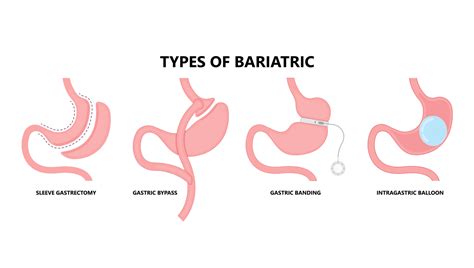 Present Trends And Future Scope Of Bariatric Surgery