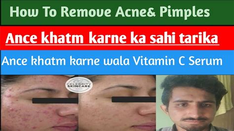 How To Remove Acneandpimples Acne Khatm Karne Wla Vitamin C Serum Acne