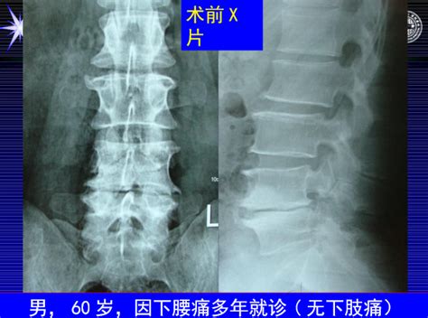 怎样判定腰椎管狭窄症的手术责任椎？ 好医术早读文章 好医术 赋能医生守护生命