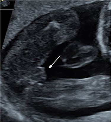 Prenatal Sonographic Features Of Chromosome Aberrations Tacg