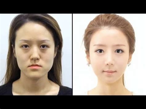 Korean Plastic Surgery Before And After Twins