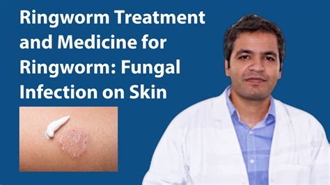 Ringworm Treatment Fungal Infection On Skin Symptoms Reason And Medicine For Ringworm