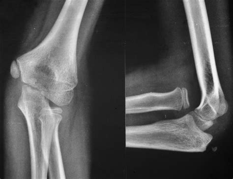 Open Reduction Ulnar Osteotomy And External Fixation For Chronic